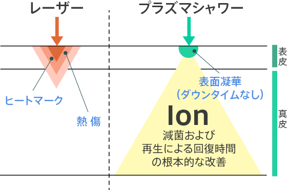 Ion 減菌および再生による回復時間の根本的な改善