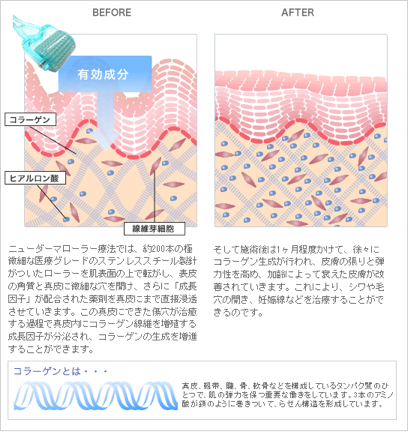 成長因子の分泌を促進しコラーゲンを増殖