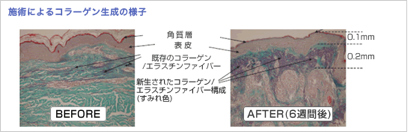 施術によるコラーゲン生成の様子