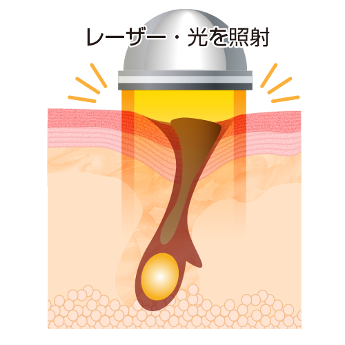毛穴の汚れや古い角質を除去