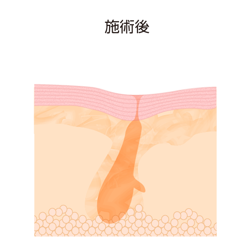 毛穴が引き締まった状態