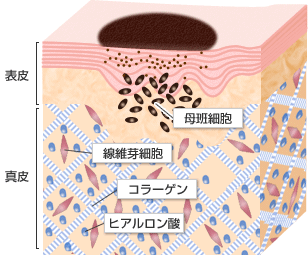 ほくろの原因