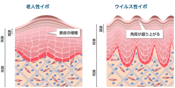 老人性イボ、ウイルス性イボ