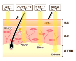 レーザー治療の種類と特長