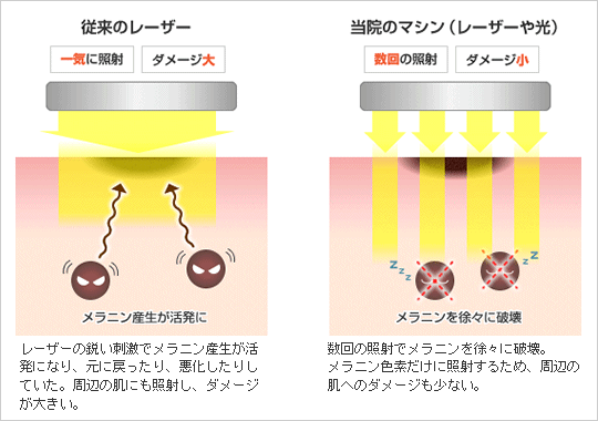 【従来のレーザー】・一気に照射 ・ダメージ大 レーザーの鋭い刺激でメラニン産生が活発になり、元に戻ったり、悪化したりしていた。周辺の肌にも照射し、ダメージが大きい。　【当院のマシン（レーザーや光）・数回の照射 ・ダメージ小 数回の照射でメラニンを徐々に破壊。メラニン色素だけに照射するため、周辺の肌へのダメージも少ない。】