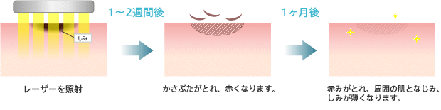 1～2週間後：かさぶたがとれ、赤くなります。1ヶ月後：赤みがとれ、周囲の肌となじみ、しみが薄くなります。