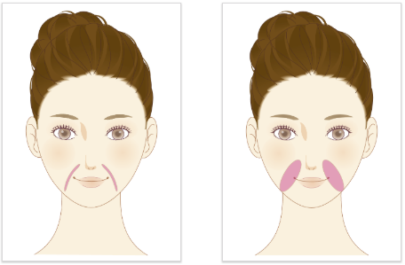 鼻唇溝（ほうれい線）の注入箇所