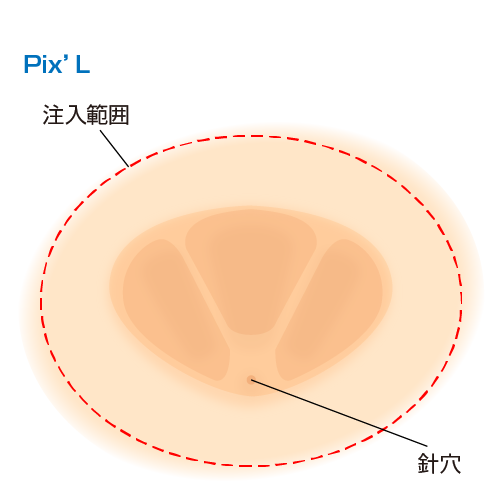 pix'Lの注入範囲と針穴