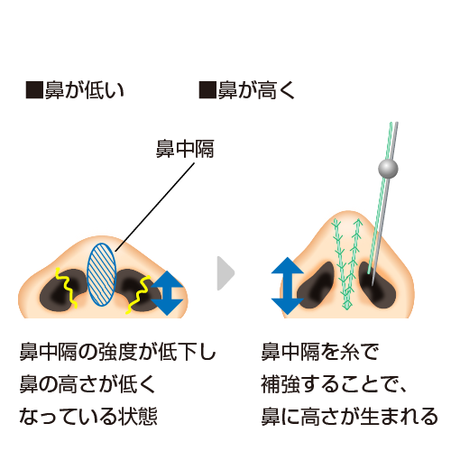 鼻が低い 鼻中隔の強度が低下し鼻の高さが低くなっている状態 鼻が高く 鼻中隔を糸で補強することで鼻に高さが生まれる