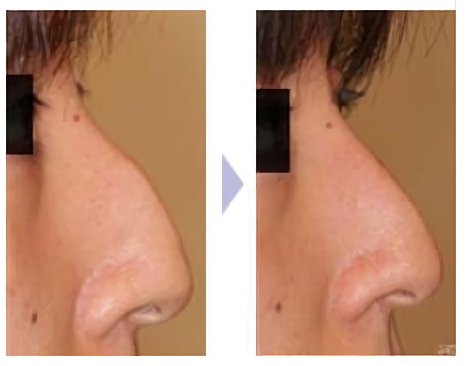 鷲鼻修正 わし鼻修正 整鼻術 低鼻術 鼻の整形 美容整形 美容外科 美容皮膚科なら聖心美容クリニック
