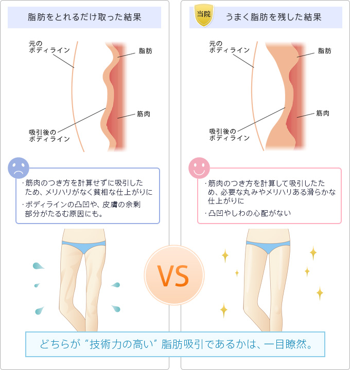 脂肪をとれるだけ取った結果：・筋肉のつき方を計算せずに吸引したため、メリハリがなく貧相な仕上がりに ・ボディライン凹凸や、皮膚の余剰部分がたるむ原因にも　　うまく脂肪を残した結果：・筋肉のつき方を計算して吸引したため、必要な丸みやメリハリある滑らかな仕上がりに ・凹凸やしわの心配がない　　「どちらが”技術力の高い”脂肪吸引であるかは一目瞭然