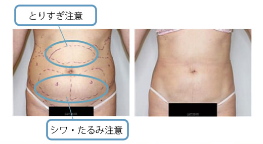 上腹部はとりすぎ注意、下腹部はシワ・たるみ注意