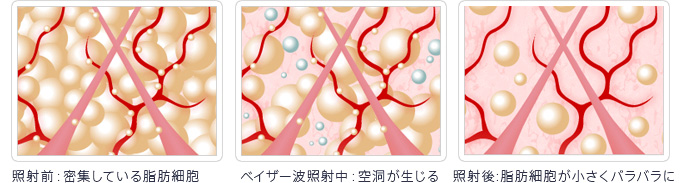 照射前：密集している脂肪細胞　ベイザー波照射中：空洞が生じる　照射後：脂肪細胞が小さくバラバラに