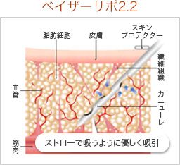 ベイザーリポ2.2はこれまでの脂肪吸引と何が違うのですか？