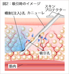 図2:吸引時のイメージ