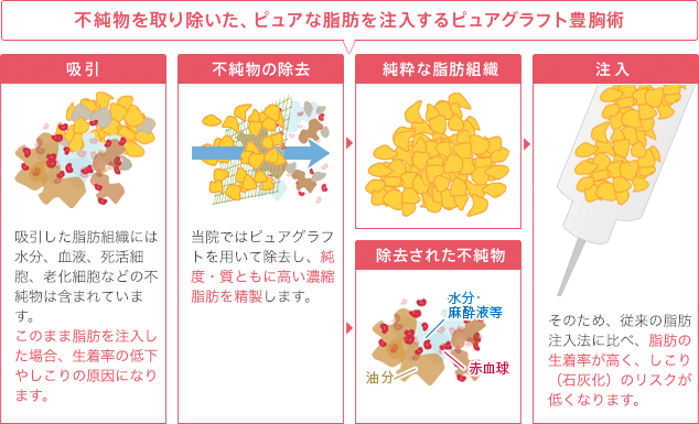 不純物を取り除いた、ピュアな脂肪を注入するピュアグラフト豊胸術