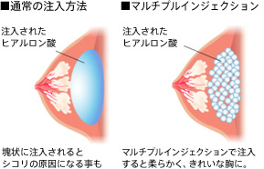 通常の注入方法 塊状に注入されるとシコリの原因になる事も マルチプルインジェクション マルチプルインジェクションで注入すると柔らかく、きれいな胸に。