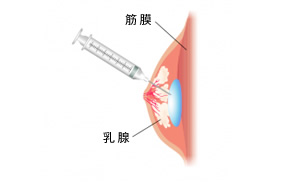 乳腺の下の深い部位に注入