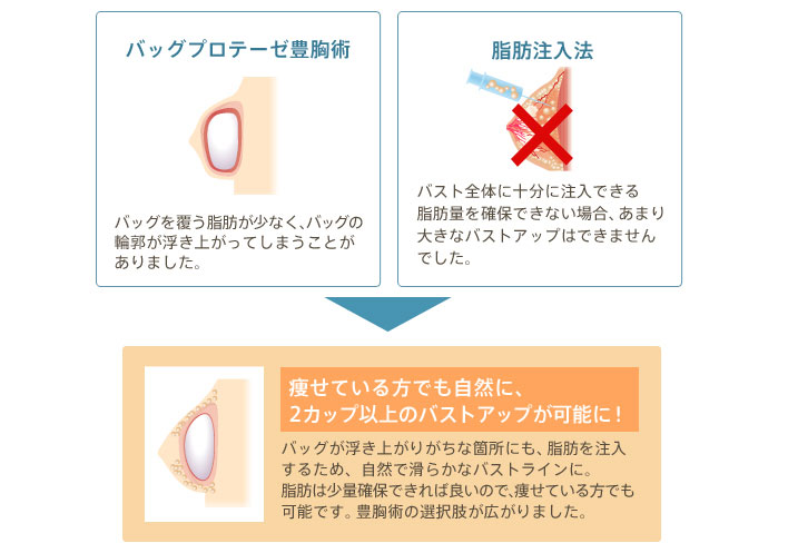 バッグプロテーゼ豊胸術 バッグを覆う脂肪が少なく、バッグの輪郭が浮き上がってしまうことがありました。 脂肪注入法 バスト全体に十分に注入できる脂肪量を確保できない場合、あまり 大きなバストアップはできませんでした。 痩せている方でも自然に、2カップ以上のバストアップが可能に！ バッグが浮き上がりがちな箇所にも、脂肪を注入するため、自然で滑らかなバストラインに。 脂肪は少量確保できれば良いので、痩せている方でも可能です。 豊胸術の選択肢が広がりました。