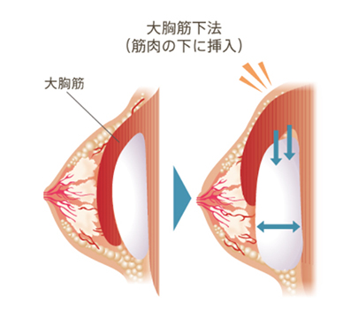 大胸筋下法（筋肉の下に挿入）