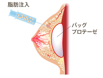 ハイブリッド豊胸術(コンポジット豊胸術)の挿入法