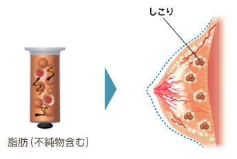 脂肪（不純物含む）、しこり