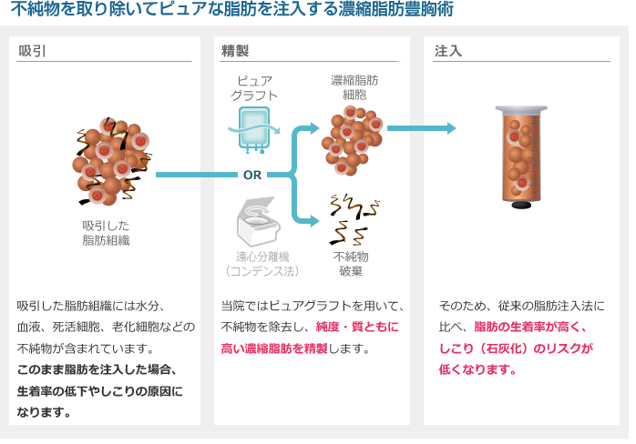 不純物を取り除いてピュアな脂肪を注入する濃縮脂肪豊胸術 吸引した脂肪組織には水分、血液、死活細胞、老化細胞などの不純物が含まれています。このまま脂肪を注入した場合、生着率の低下やしこりの原因になります。 当院ではピュアグラフトを用いて、不純物を除去し、純度質ともに 高い濃縮脂肪を精製します。 そのため、従来の脂肪注入法に比べ、脂肪の生着率が高く、しこり (石灰化) のリスクが低くなります。