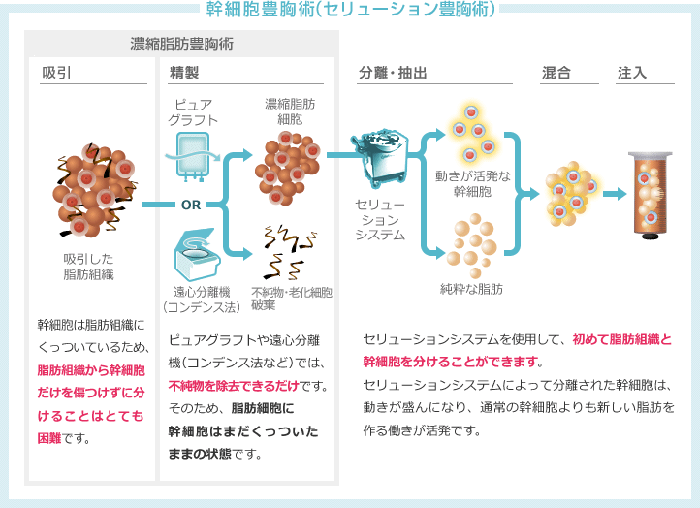 幹細胞豊胸術（セリューション豊胸術） 吸引 幹細胞は脂肪組織にくっついているため、脂肪組織から幹細胞だけを傷つけずに分けることはとても困難です。 精製 ピュアグラフトや遠心分離機（コンデンス法など）では、不純物を除去できるだけです。そのため、脂肪細胞に幹細胞はまだくっついたままの状態です。 分離・抽出 混合 注入 セリューションシステムを利用して、初めて脂肪組織と幹細胞を分けることができます。 セリューションシステムによって分離された幹細胞は、動きが盛んになり、通常の幹細胞よりも新しい脂肪を作る動きが活発です。