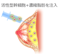活性型幹細胞+濃縮脂肪を注入