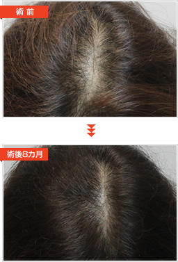 KERASTEM（ケラステム）毛髪再生 症例写真 術前 術後8カ月