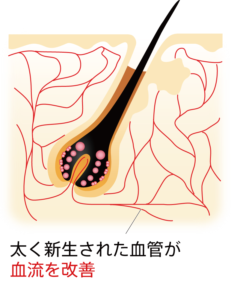 太く新生された血管が血流を改善