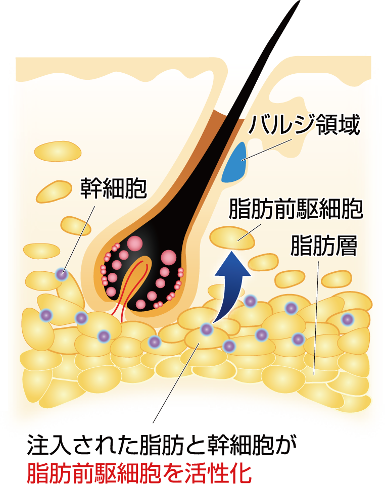 注入された脂肪と関西像が脂肪前駆細胞を活性化