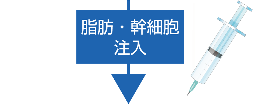 脂肪・幹細胞注入