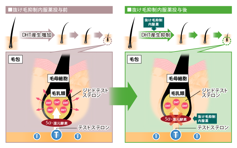 5α-還元酵素を阻害し、DHTの産生を抑制することで抜け毛を予防します