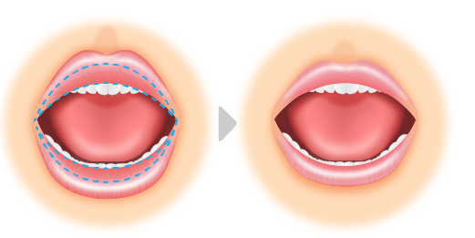 唇を薄くする 口唇縮小術 唇の整形 ガミースマイル改善 その他 顔のパーツの整形 美容整形 美容外科 美容皮膚科なら聖心美容クリニック