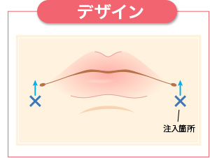 注入箇所