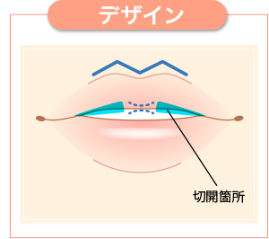 切開箇所