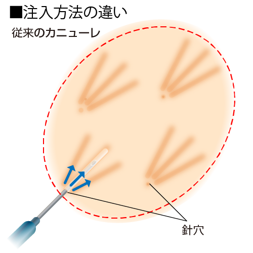 注入方法の違い　カニューレ