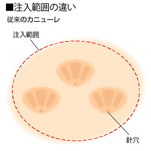 注入範囲の違い　カニューレ