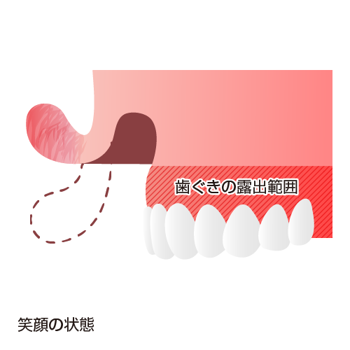 口元を横から見た断面図：笑顔の状態