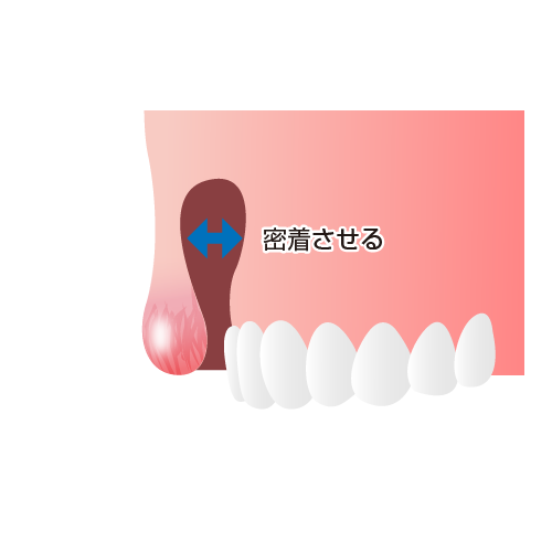 上唇と歯ぐきを密着させる