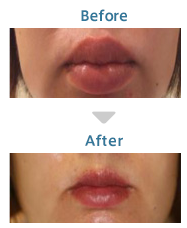 唇の整形 ガミースマイル改善 美容整形 美容外科 美容皮膚科なら聖心美容クリニック