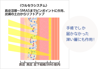 ＜ドクターハイフ（ウルセラシステム）＞真皮深層～SMASまでピンポイントに作用、皮膚の土台からリフトアップ