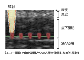 エコー画像で真皮深層とSMAS層を常に確認しながら照射