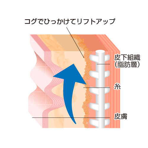 コグでひっかけてリフトアップ