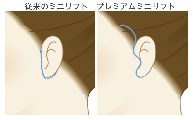 プレミアムミニリフト