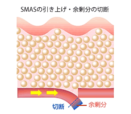 SMASの引き上げ・余剰分の切断