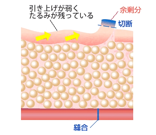 引き上げが弱くたるみが残っている