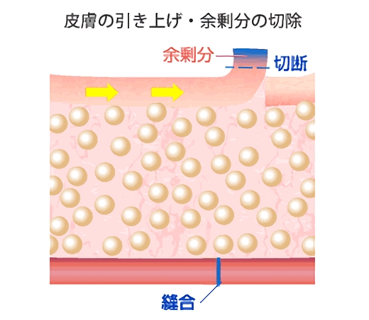 皮膚の引き上げ・余剰分の切断