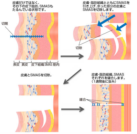 皮膚だけではなく、その下の皮下脂肪、SMASもたるんでいる状です。 皮膚・脂肪組織とともにSMASを引き上げ、余った部分の皮膚とSMASを切除します。 皮膚とSMASを切除。 皮膚・脂肪組織、SMASそれぞれを縫合します。(1週間後に抜糸)